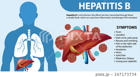Symptoms of Hepatitis B Infographic Symptoms of Hepatitis B Infographic 107173734