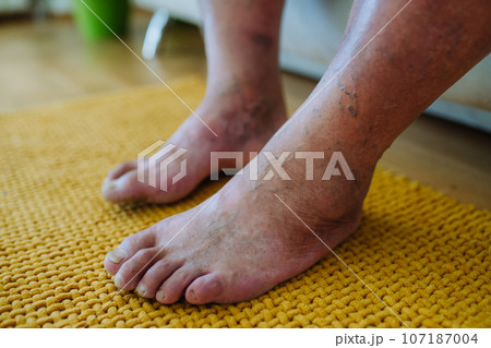 A close-up shot of man's feet with diabetic foot complications. A close-up shot of man's feet with diabetic foot complications. 107187004