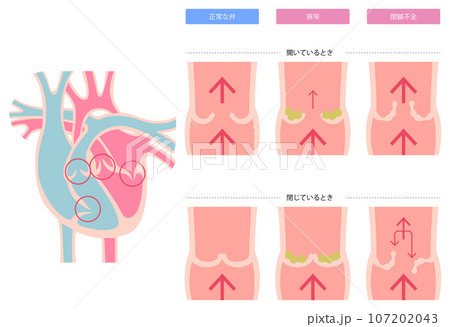 心臓弁膜症の図解 107202043