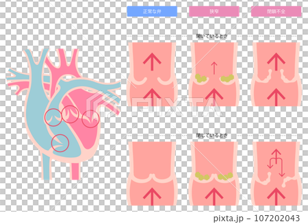 心臓弁膜症の図解 107202043