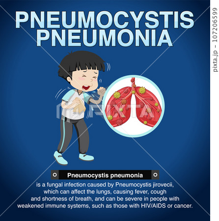 Informative poster of Pneumocystis Pneumoniaのイラスト素材 [107206599] - PIXTA