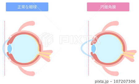 円錐角膜の図解 107207306