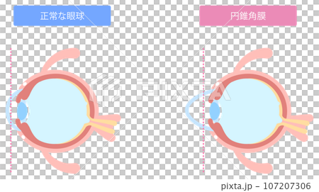 円錐角膜の図解 107207306