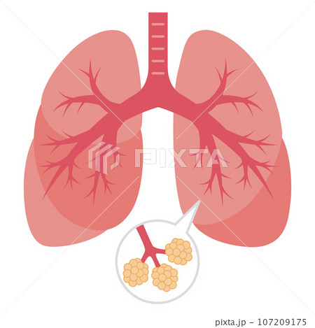 肺のイラスト 107209175