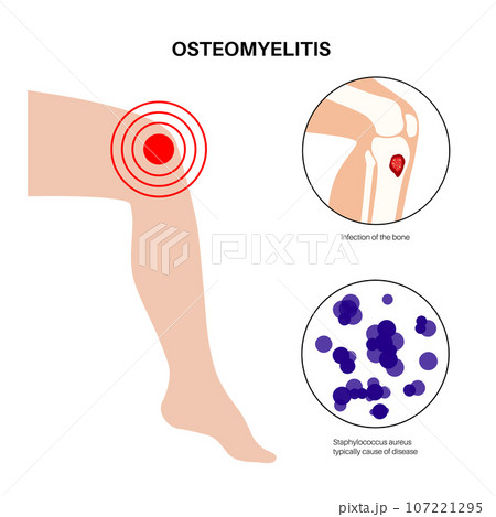 Tibia bone osteomyelitis 107221295