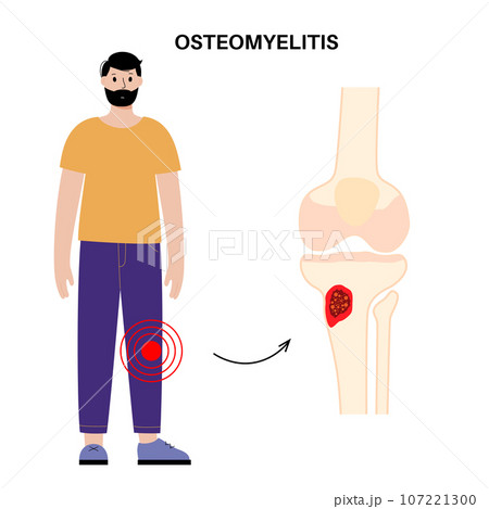 Tibia bone osteomyelitis 107221300