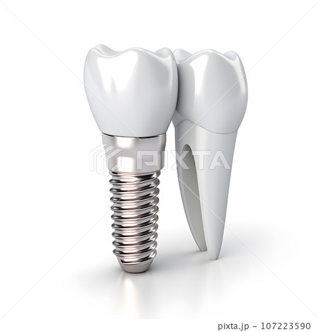 The concept of dental implant surgery. Image of implants on a white background The concept of dental implant surgery. Image of implants on a white background 107223590