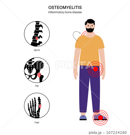 Osteomyelitis in adults 107224280