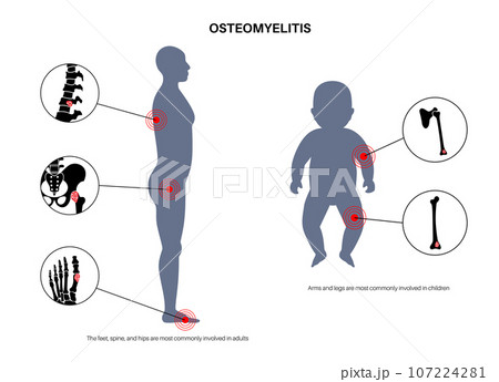 Osteomyelitis disease poster 107224281