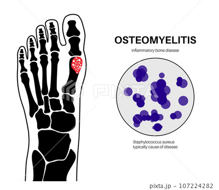Osteomyelitis of feet 107224282