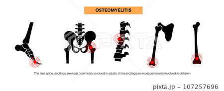 Osteomyelitis disease poster 107257696