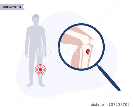 Tibia bone osteomyelitis Tibia bone osteomyelitis 107257705