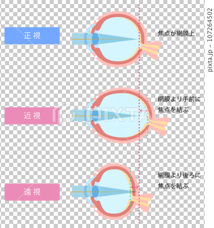 正視、近視和遠視的區別圖解 107264502