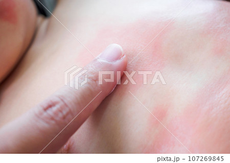 Doctor hand applying topical antihistamine medicine cream on little girl body with severe skin rash and allergy Doctor hand applying topical antihistamine medicine cream on little girl body with severe skin rash and allergy 107269845