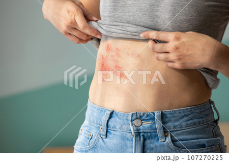 Painful shingles in woman 107270225
