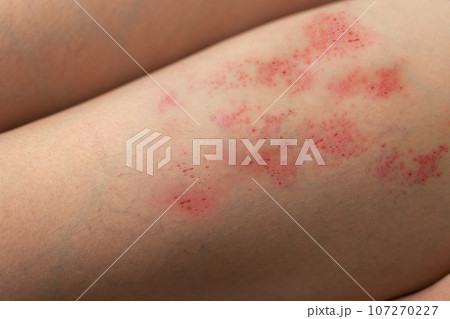 Painful shingles in woman Painful shingles in woman 107270227