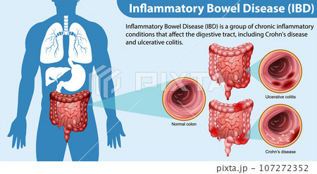 Inflammatory Bowel Disease (IBD) Infographic Inflammatory Bowel Disease (IBD) Infographic 107272352