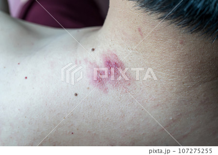 Skin disease Skin disease 107275255