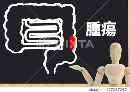 腫瘍 腫瘍 107287267