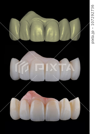 Three stages of making full dental zirkonium prosthesis on implants. Dental care concept. Three stages of making full dental zirkonium prosthesis on implants. Dental care concept. 107292736