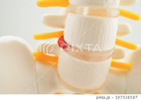 Spinal nerve and bone, Lumbar spine displaced herniated disc fragment, Model for treatment medical in the orthopedic department. 107316587