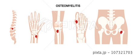 Osteomyelitis disease poster 107321703