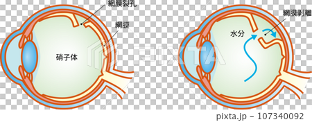 Eye symptoms from retinal tear to retinal detachment Eye symptoms from retinal tear to retinal detachment 107340092