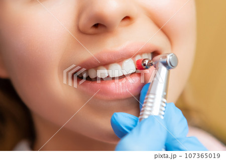 Close-up dentist performing teeth grinding procedure in dental clinic. Woman visits doctor grinding teeth to create perfect smile in private hospital 107365019