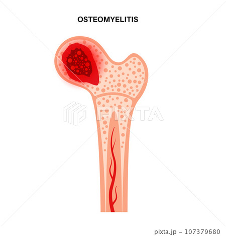 Osteomyelitis of hip 107379680