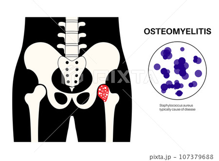 Osteomyelitis of hip Osteomyelitis of hip 107379688