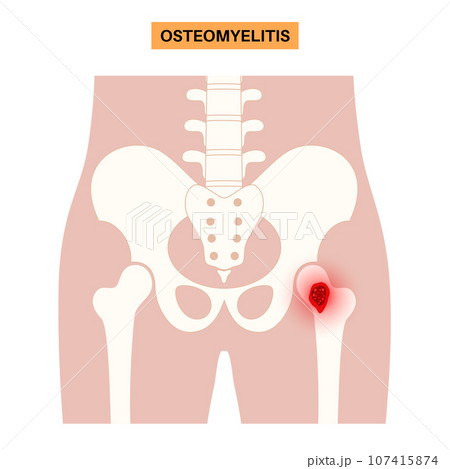 Osteomyelitis of hip 107415874