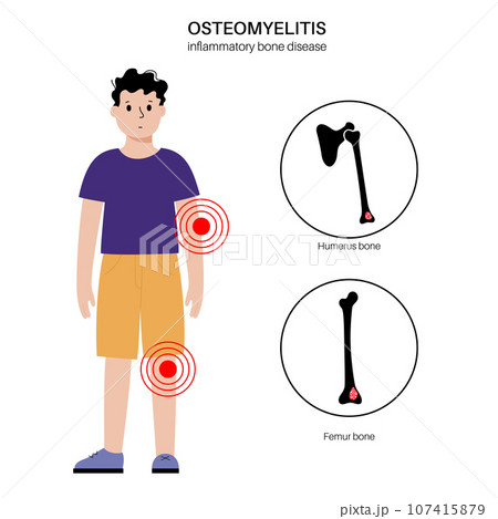 Osteomyelitis in children 107415879