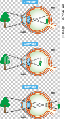 Emmetropia, myopia, hyperopia, eye structure with text 107436180