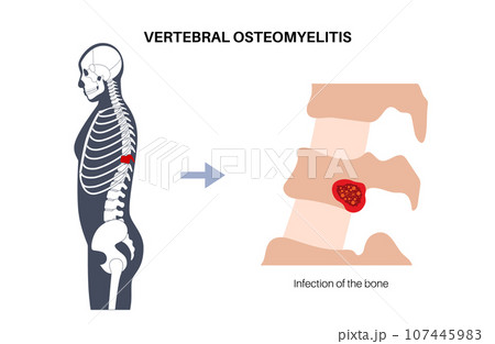 Vertebral osteomyelitis poster 107445983