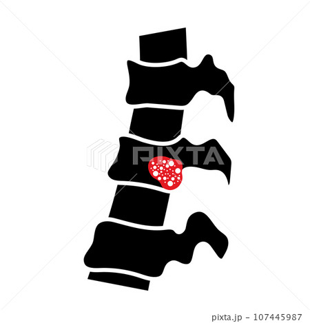 Vertebral osteomyelitis poster 107445987