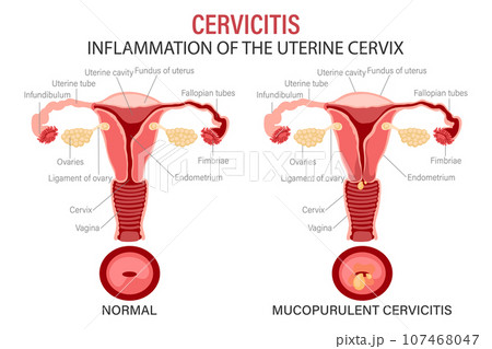 Cervicitis, diseases of the female reproductive system. Schematic representation of the uterus and cervix. Medical infographic banner. Vector Cervicitis, diseases of the female reproductive system. Schematic representation of the uterus and cervix. Medical infographic banner. Vector 107468047