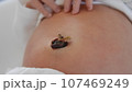 Newborn baby's belly button stump With drying umbilical cord. 107469249