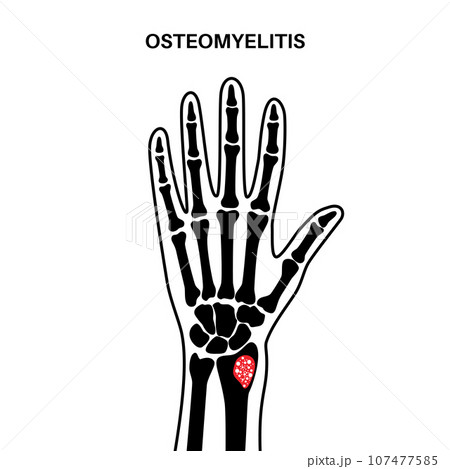 Osteomyelitis of arm 107477585