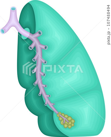肺　気管支分岐　イラスト 107488494