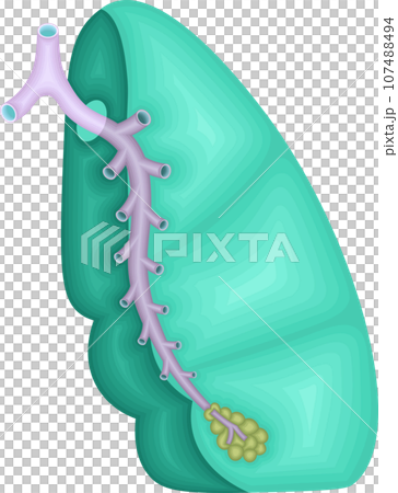 肺　気管支分岐　イラスト 107488494