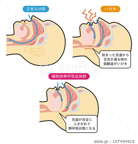 睡眠時の呼吸の解説イラスト 睡眠時の呼吸の解説イラスト 107494928