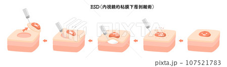 内視鏡 ESD 内視鏡的粘膜下層剥離術 内視鏡 ESD 内視鏡的粘膜下層剥離術 107521783