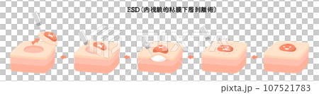 内視鏡 ESD 内視鏡的粘膜下層剥離術 内視鏡 ESD 内視鏡的粘膜下層剥離術 107521783