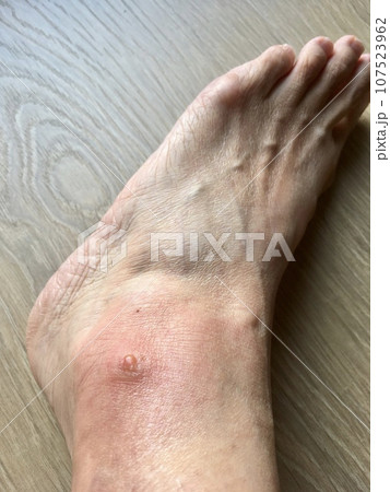 虫刺され 赤みと腫れ 膿 虫刺され 赤みと腫れ 膿 107523962