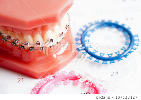 Orthodontic ligatures rings and ties, elastic rubber bands on orthodontic braces, model for dentist studying about dentistry. Orthodontic ligatures rings and ties, elastic rubber bands on orthodontic braces, model for dentist studying about dentistry. 107533127