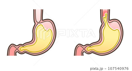 胃食道逆流症のイラスト 107540976