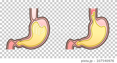 胃食道逆流症のイラスト 107540976