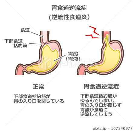 胃食道逆流症のイラスト 107540977