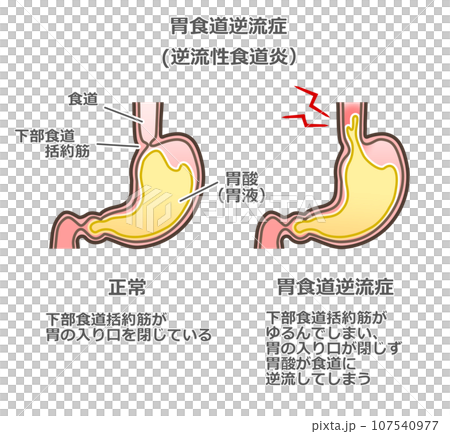 胃食道逆流症のイラスト 107540977