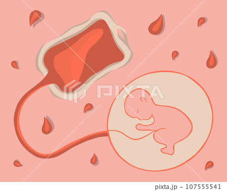 Vector isolated illustration of umbilical cord blood. Stem cells. Freezing stem cells. Collection of umbilical cord blood. 107555541